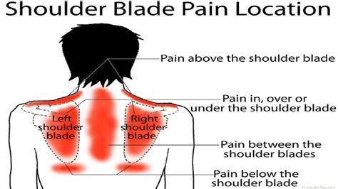 Pinched Nerve In Shoulder Blade