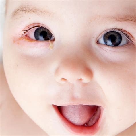 Pinkeye In Newborn