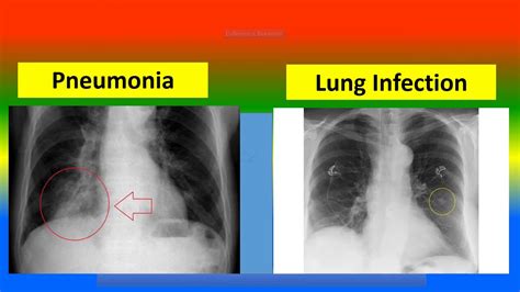 Pneumonia And Double Pneumonia