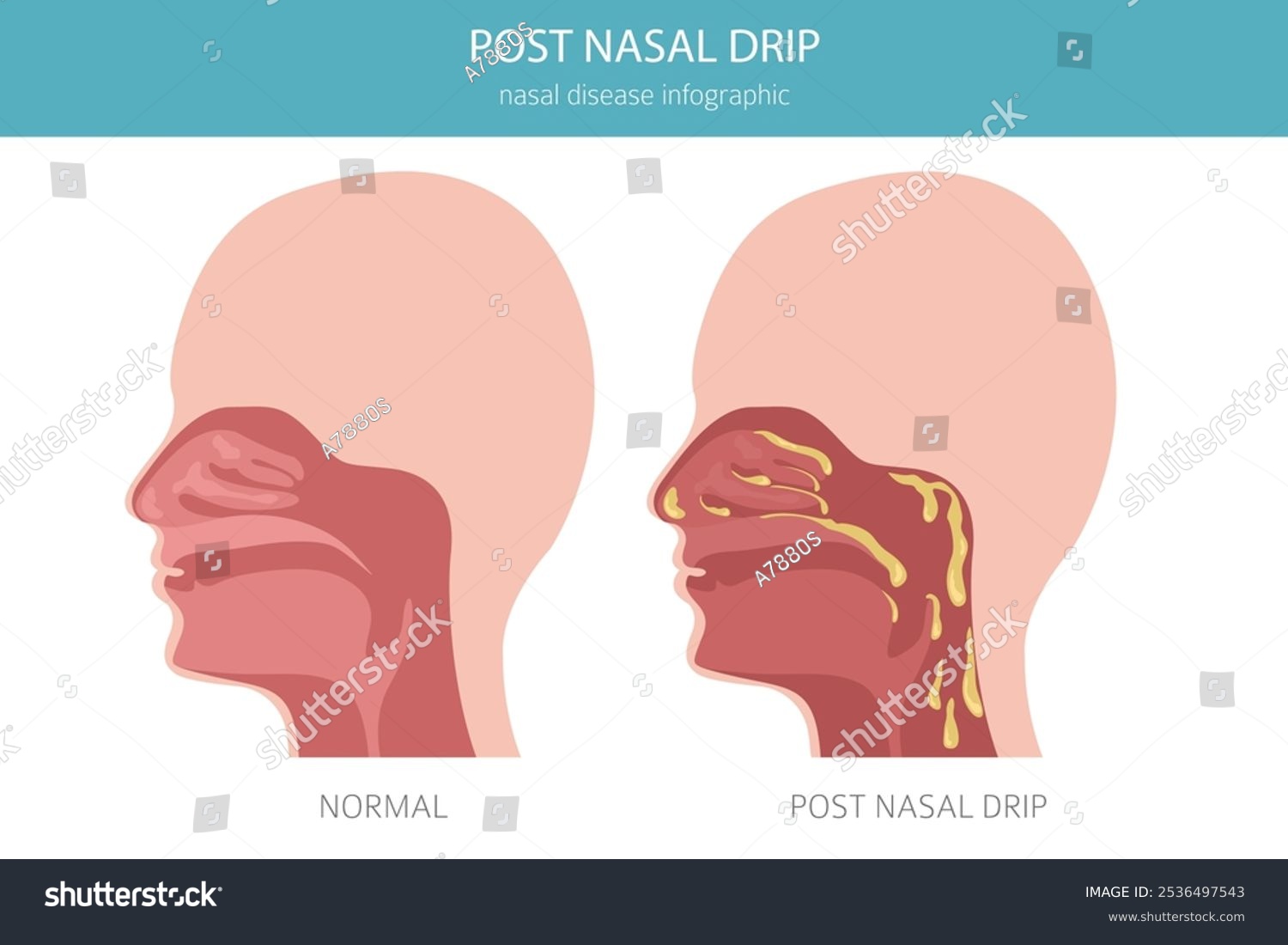 Post Removal Of Wisdom Teeth