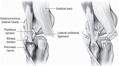 Posterolateral Corner Injury