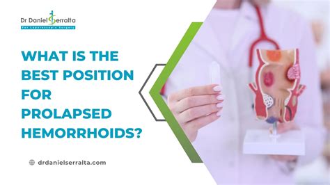 Prolapsed Internal Hemorrhoids