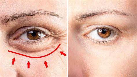 Puffiness Of Eye