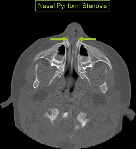 Pyriform Aperture Stenosis