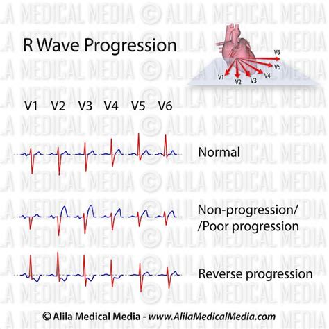 R Wave Progression