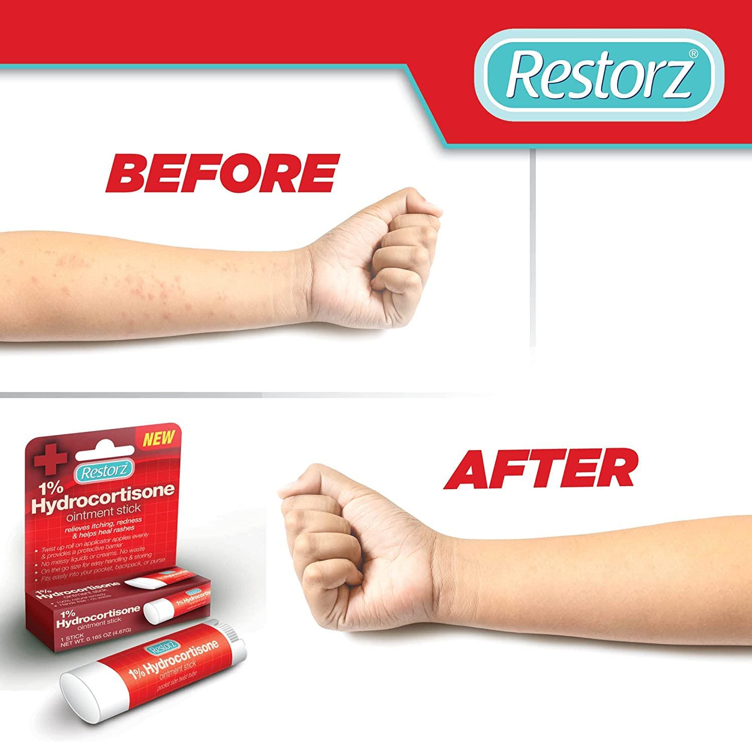 Rashes Vs Hives