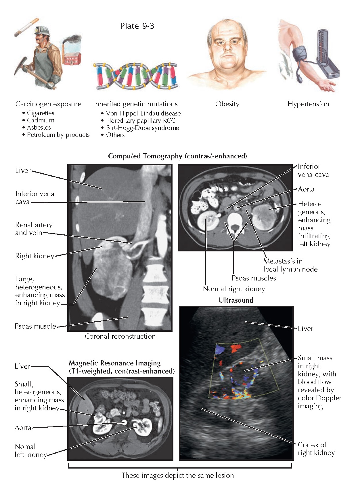 Renal Calculi 7Mm