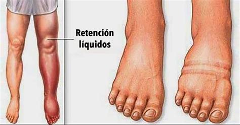 Retencion De Liquidos
