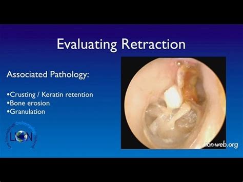 Retraction Pocket Of Tympanic Membrane