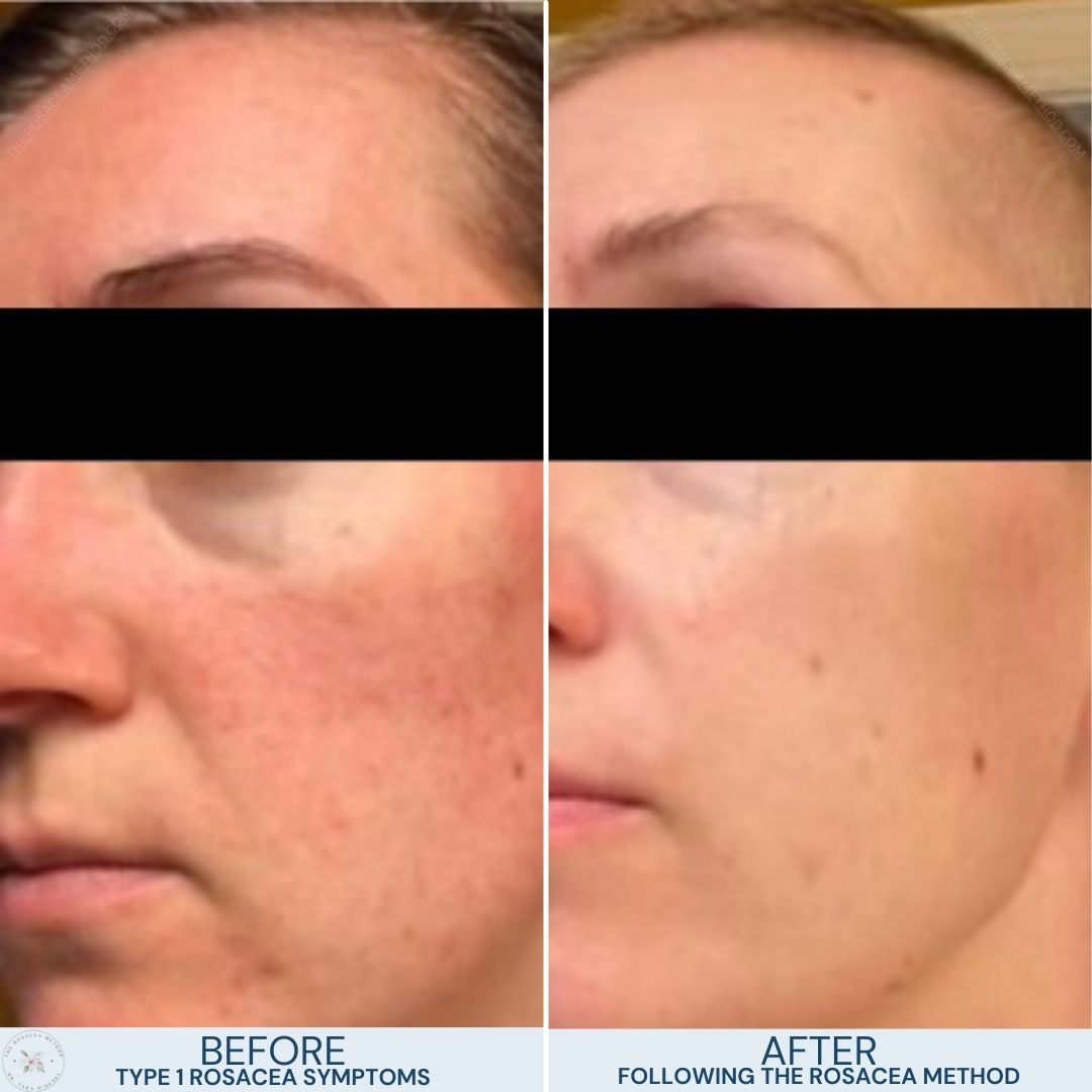Rosacea Redness Laser Treatment