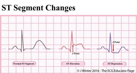 S T Segment
