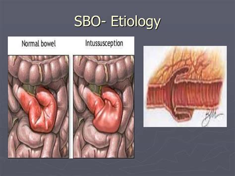 Sbo Medical Abbreviation