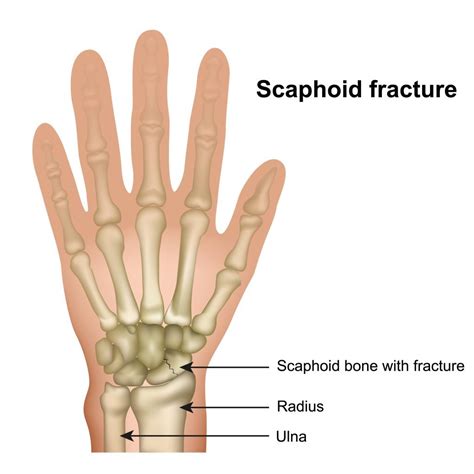 Scaphoid Bone Fracture
