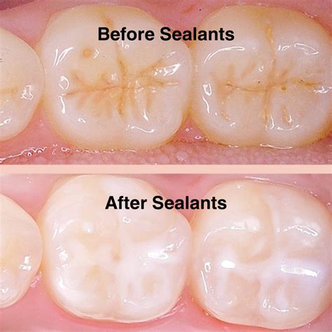 Sealants For Teeth
