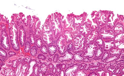 Sessile Serrated Adenoma