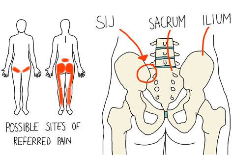 Si Joint Pain Symptoms