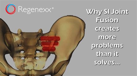 Si Joint Surgery