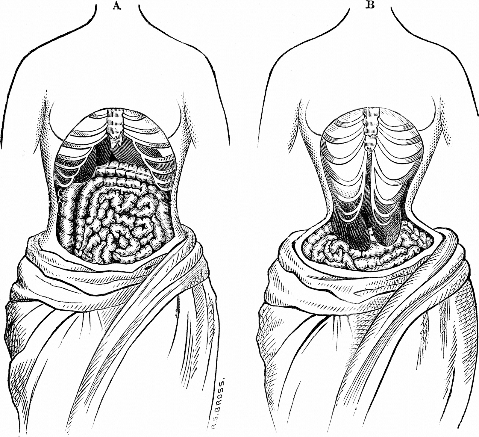 The Smallest Waist In The World: Xray Evidence And Facts