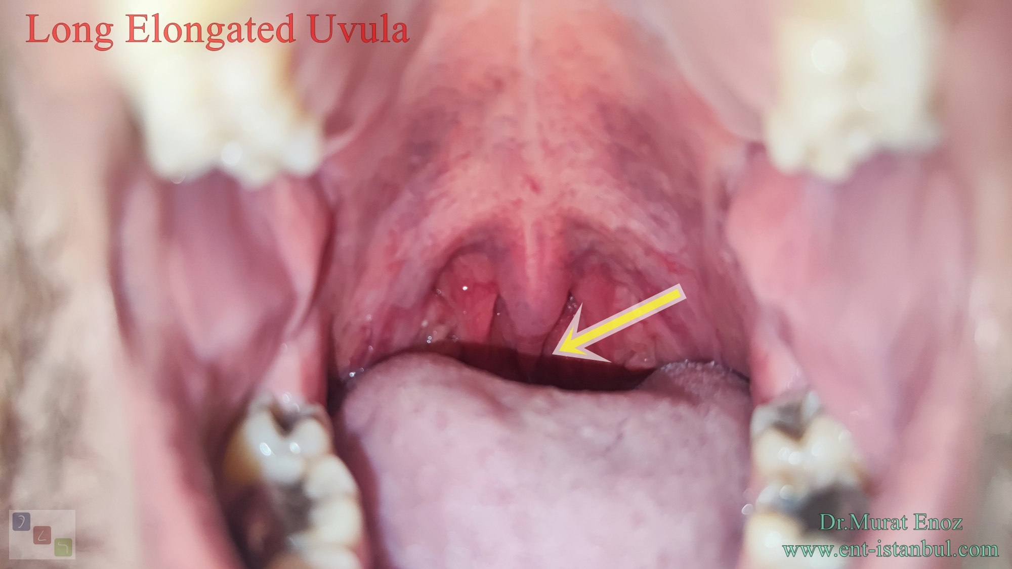 Snoring Treatment Near Me