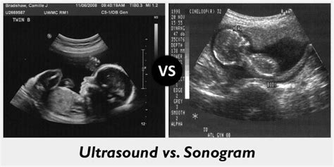 Sonogram Vs Ultrasound