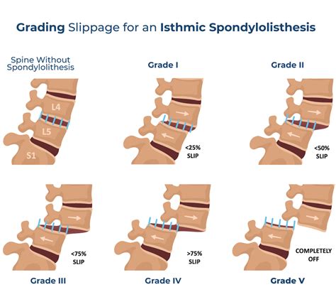 Spondylolisthesis Grade 1