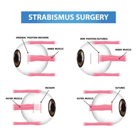 Strabismus Eye Surgery