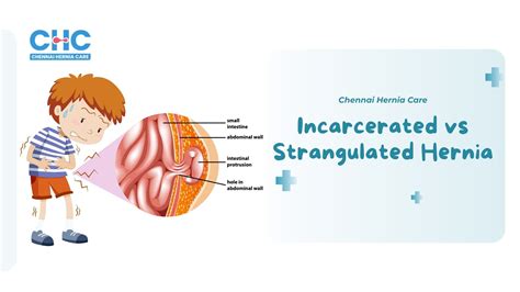 Strangulated Vs Incarcerated Hernia