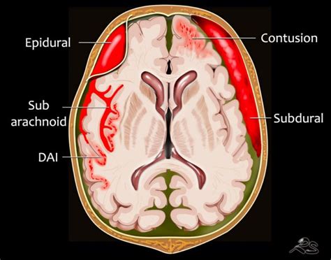Subarachnoid Hemorrhage Vs Subdural Hematoma