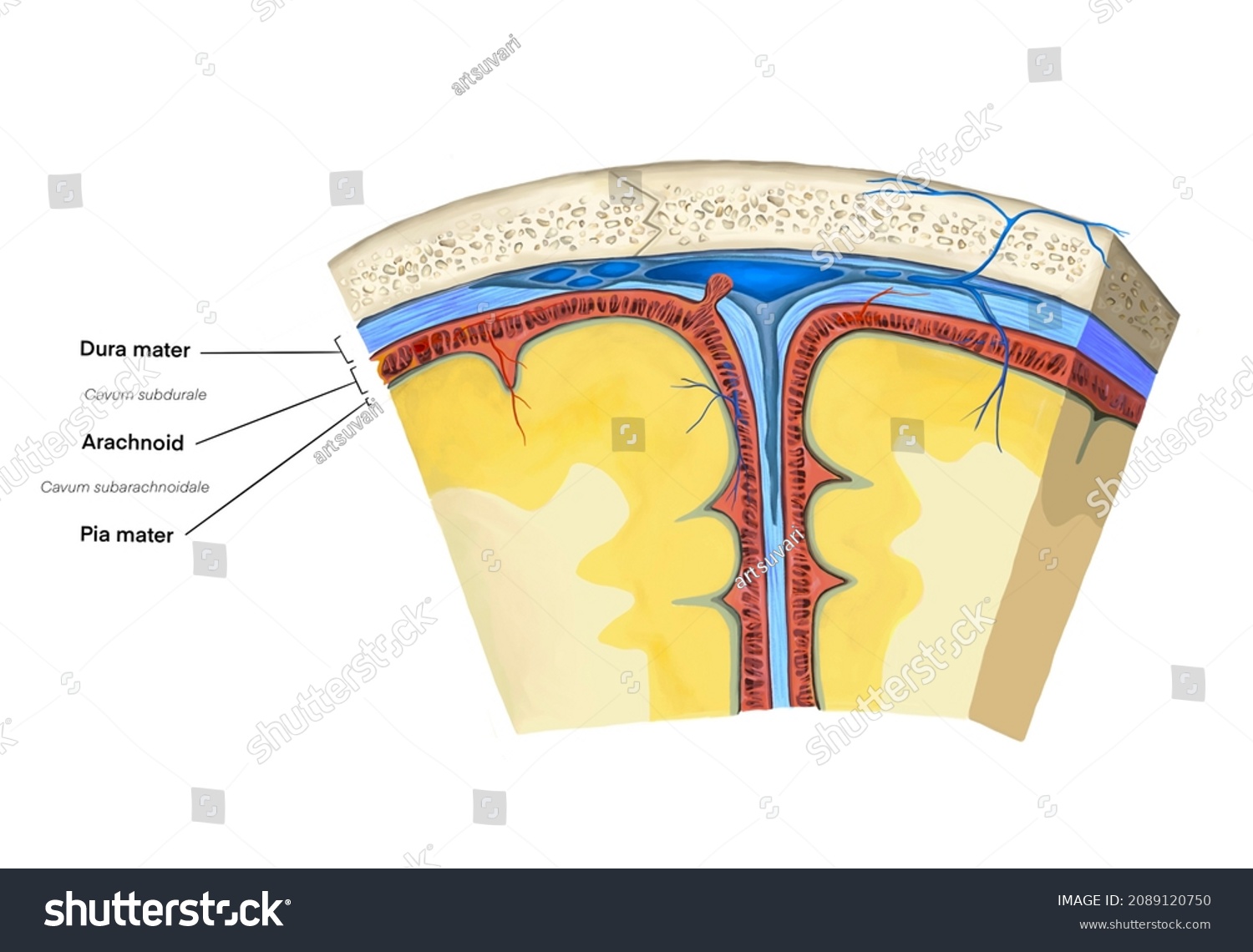 Subdural Hematoma Manifestations