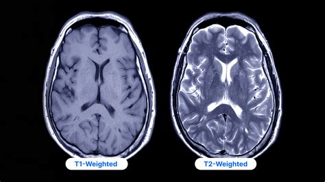 T1 Vs T2 In Mri
