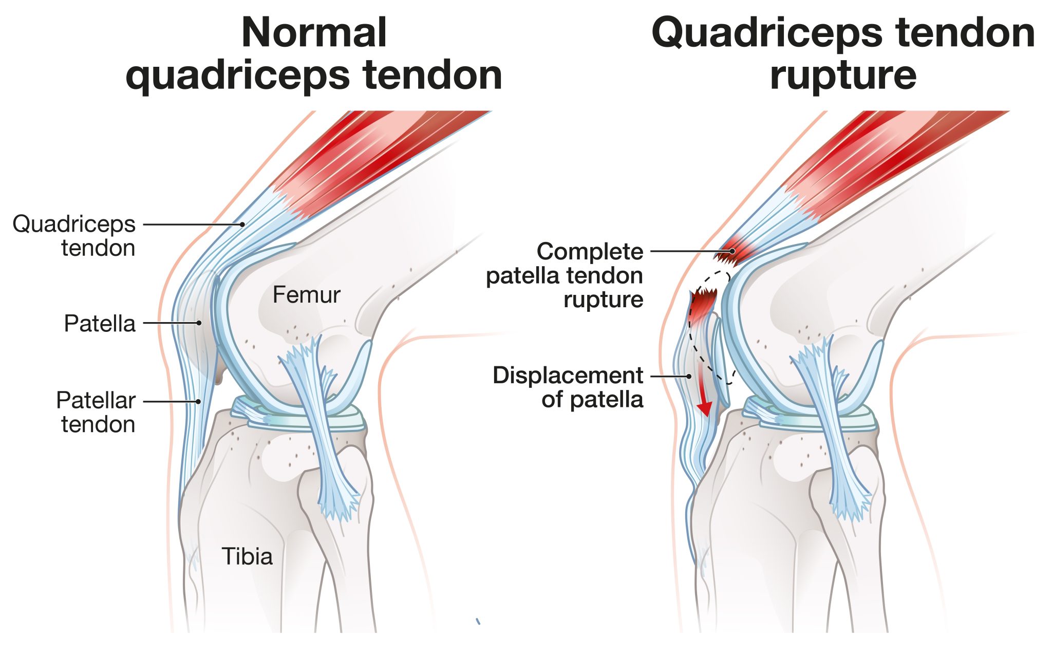 Tendonitis Top Of Foot