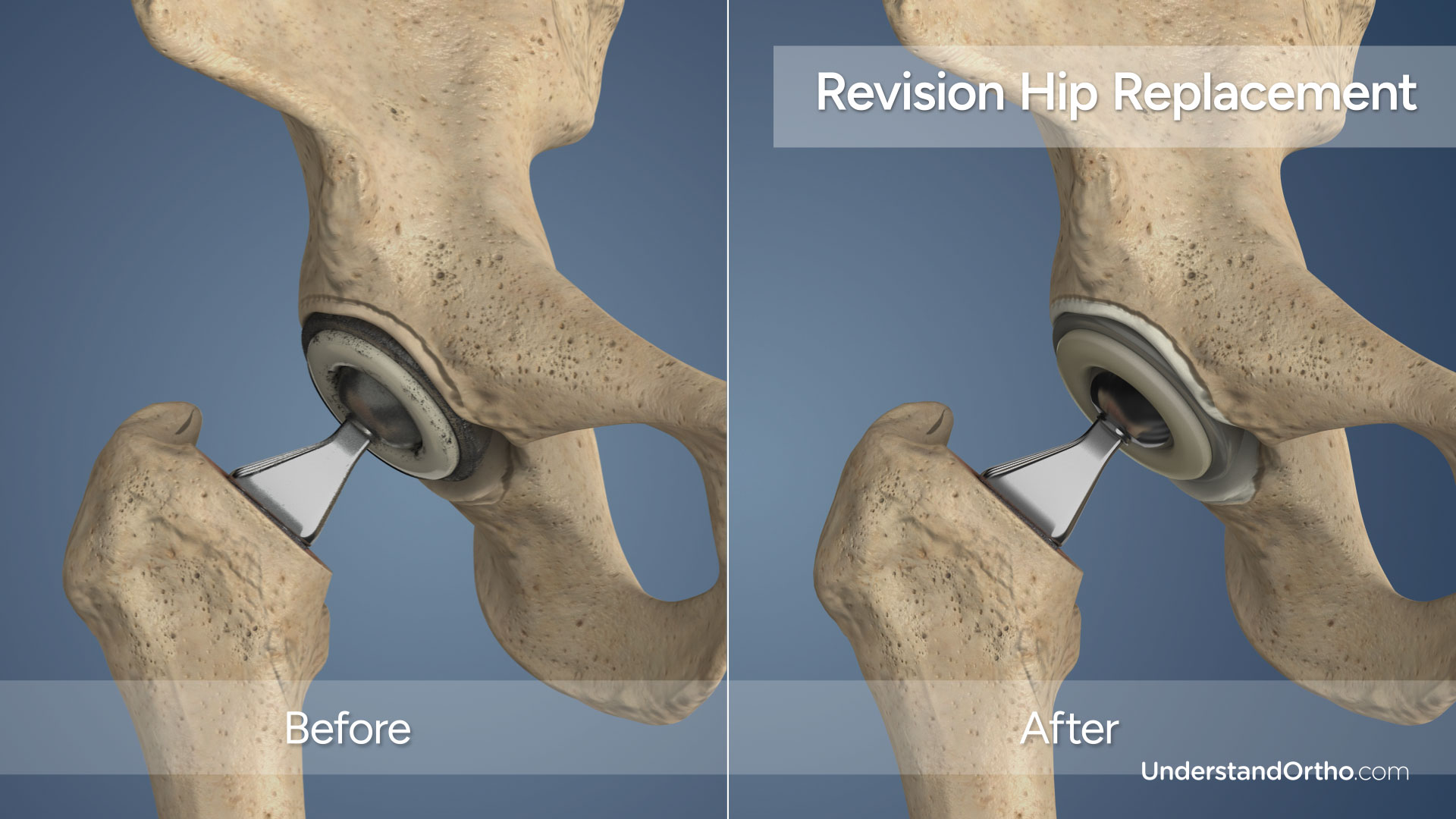 Tendons Behind The Knee Hurt
