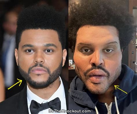 The Weeknd Surgery Face