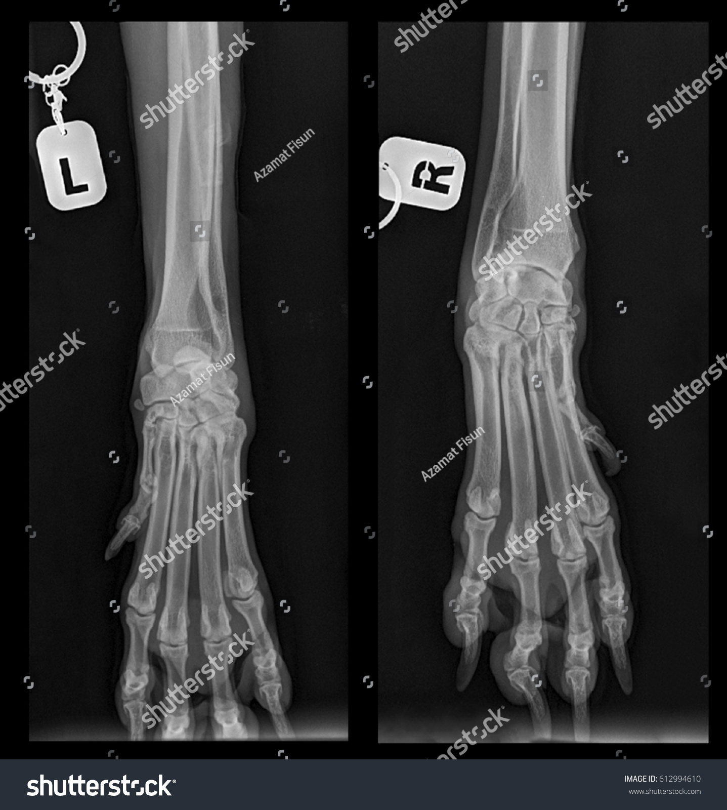 Tibia A Fibula