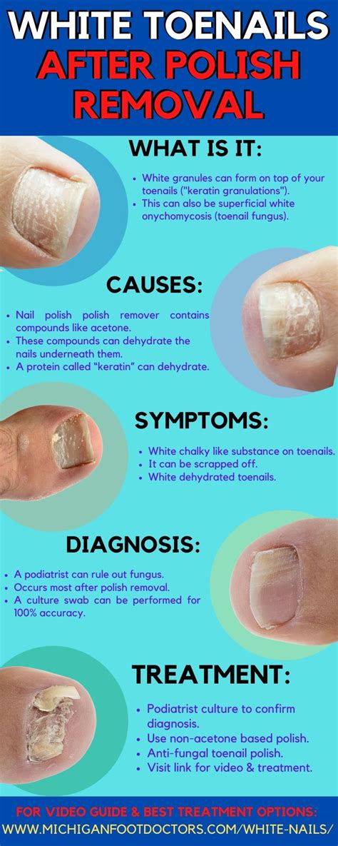 Toenail White And Chalky
