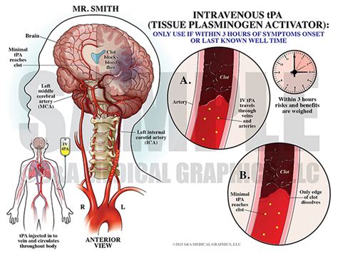 Tpa Medical Abbreviation