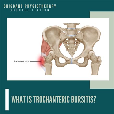 Trochanteric Bursitis Symptoms