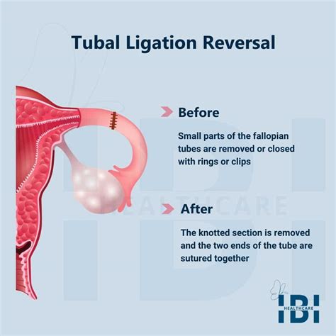 Tubal Ligation Surgery Reversal