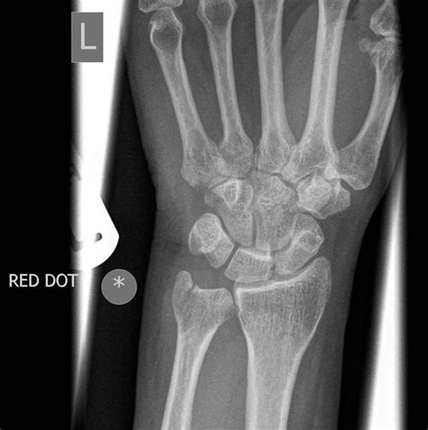 Ulnar Styloid Fracture
