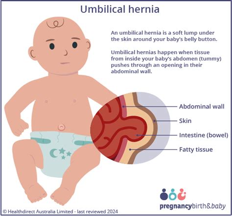 Umbilical Cord Hernia
