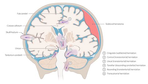 Uncal Herniation Brain