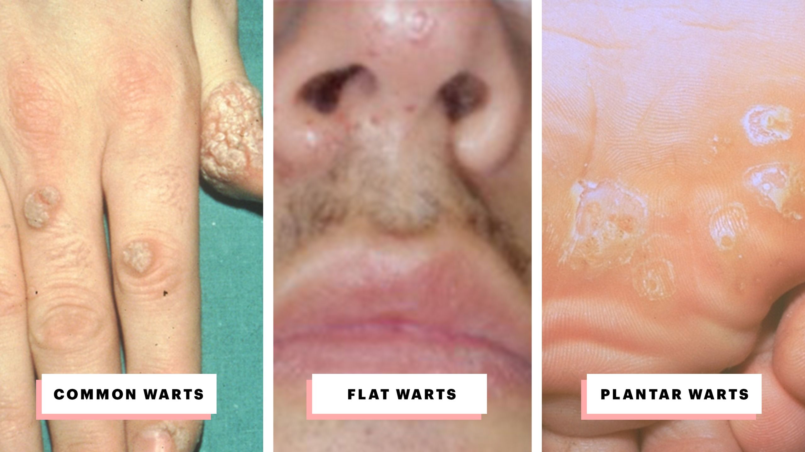 Warts On Foot