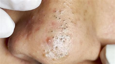 What Are Blackheads