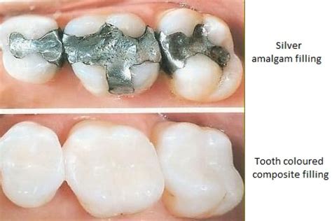 What Are Fillings For Teeth