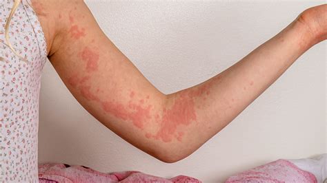 What Are Hives