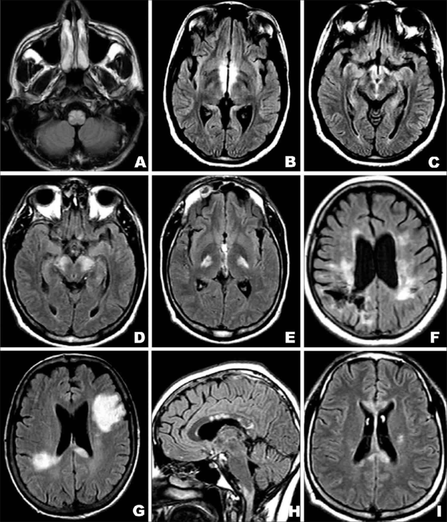 What Is A Brain Lesion? A Clear Guide To Causes And Symptoms