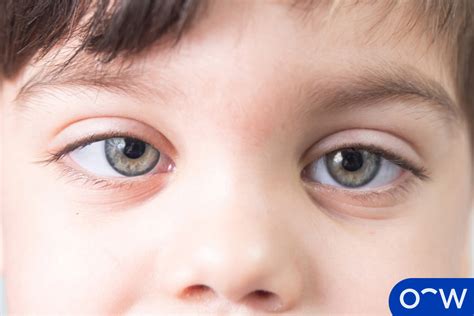 What Causes A Lazy Eye