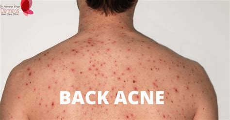 What Causes Back Acne