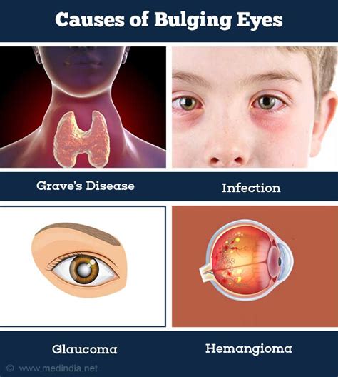 What Causes Bulging Eyes