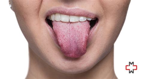 What Causes Bumps On Tongue